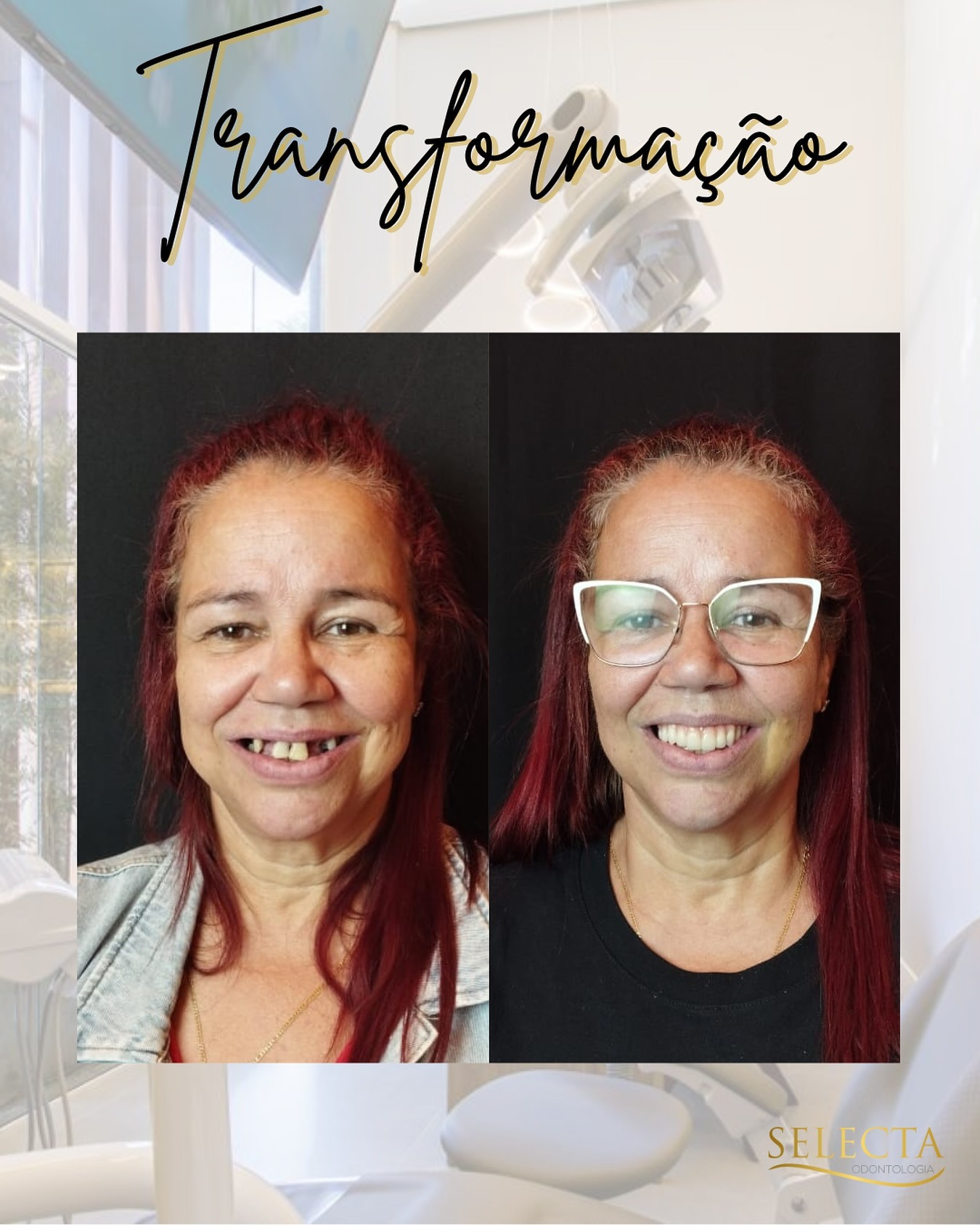 Transformação de sorriso — reabilitação com implantes dentários