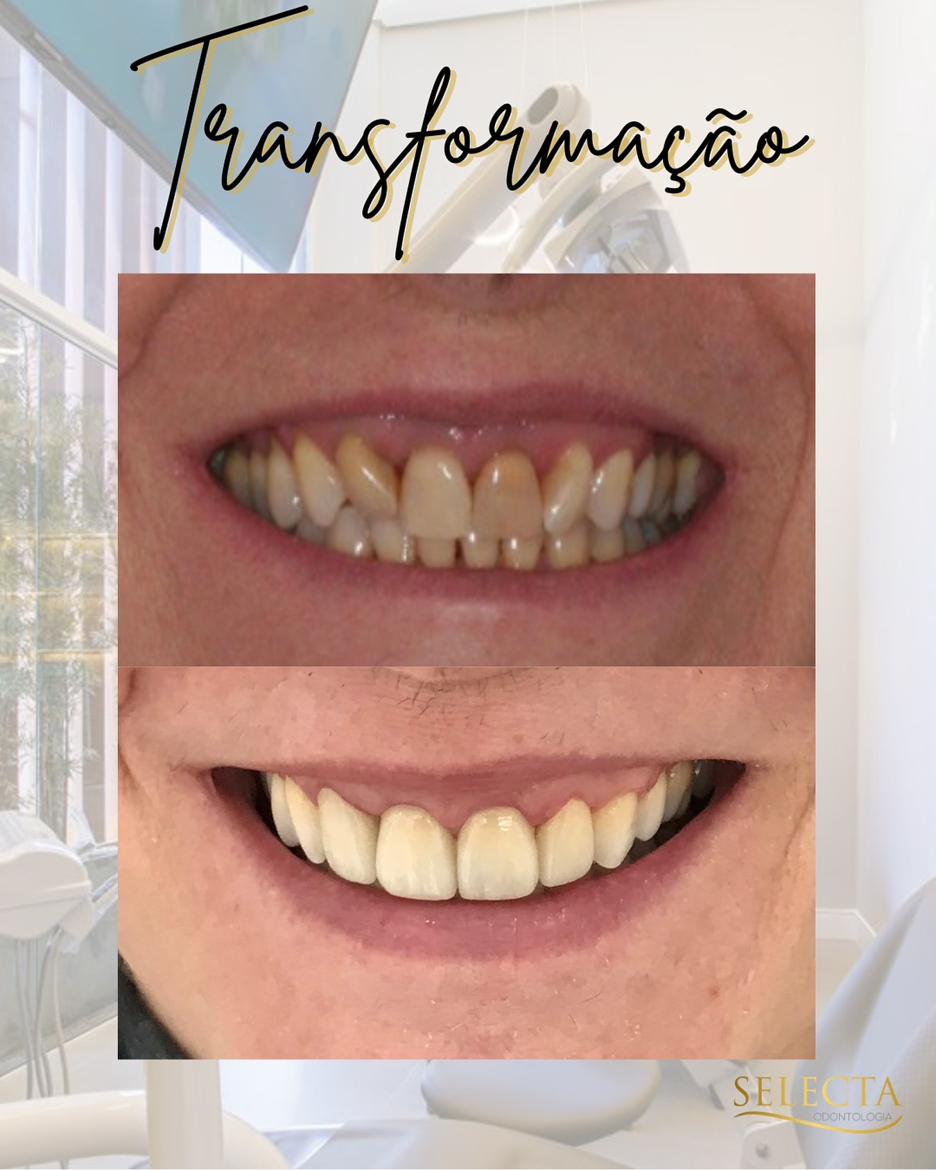 Transformação de sorriso — antes e depois com lentes de contato dental